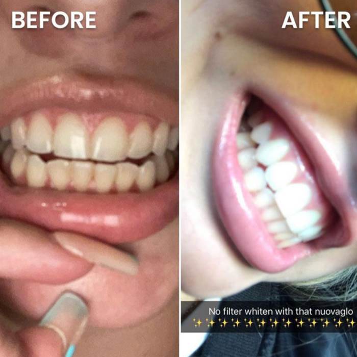 Before and after comparison of teeth with a dental tool, showing a significant improvement.
