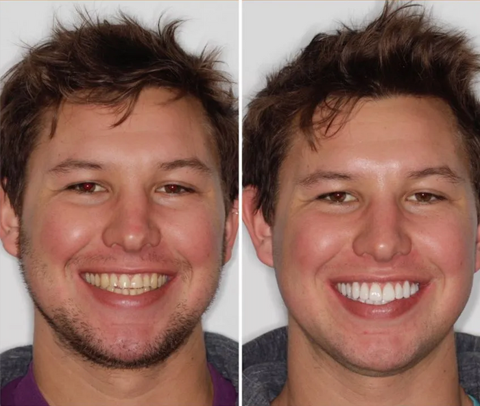 Before and after comparison of a man with a smile, showing a close-up of his face.